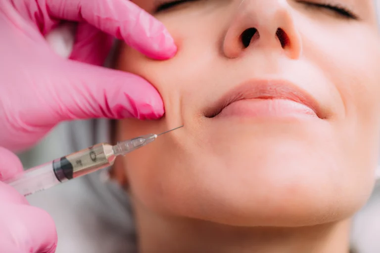 dermal filler nasolabial lines